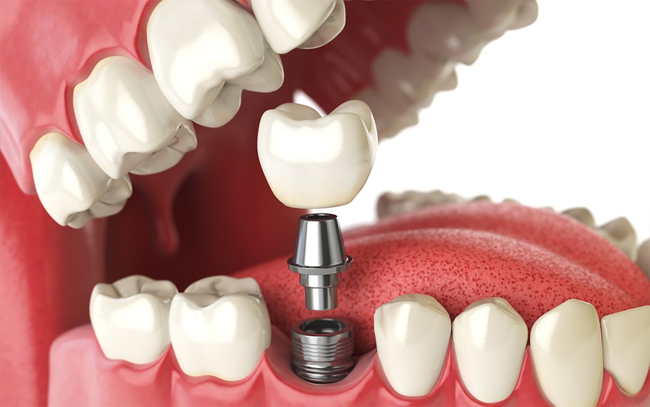 Implante dentário